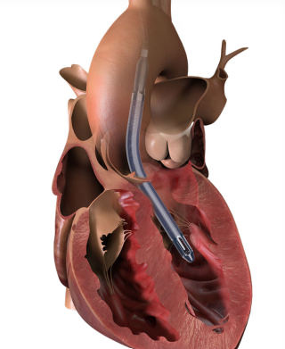 foto impella 5.5
