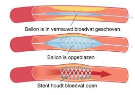 PAV dotterbehandeling