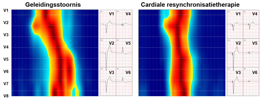 Plaatje geleidingsstoornis en Cardiale resynchronisatietherapie